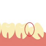 親知らずの生え方タイプ別歯磨き