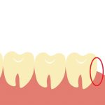 親知らずの生え方タイプ別歯磨き