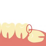 親知らずの生え方タイプ別歯磨き